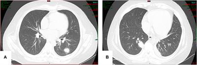 Observation of Voriconazole in the Treatment of Liver Failure Complicated With Invasive Pulmonary Fungal Infection Induced by Chinese Patent Medicine in Teenagers: 2 Case Reports